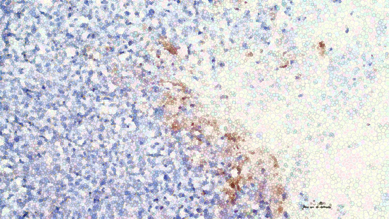 Cancer Breakthrough: 'Like an Arrow That Hits Only the Bullseye'
