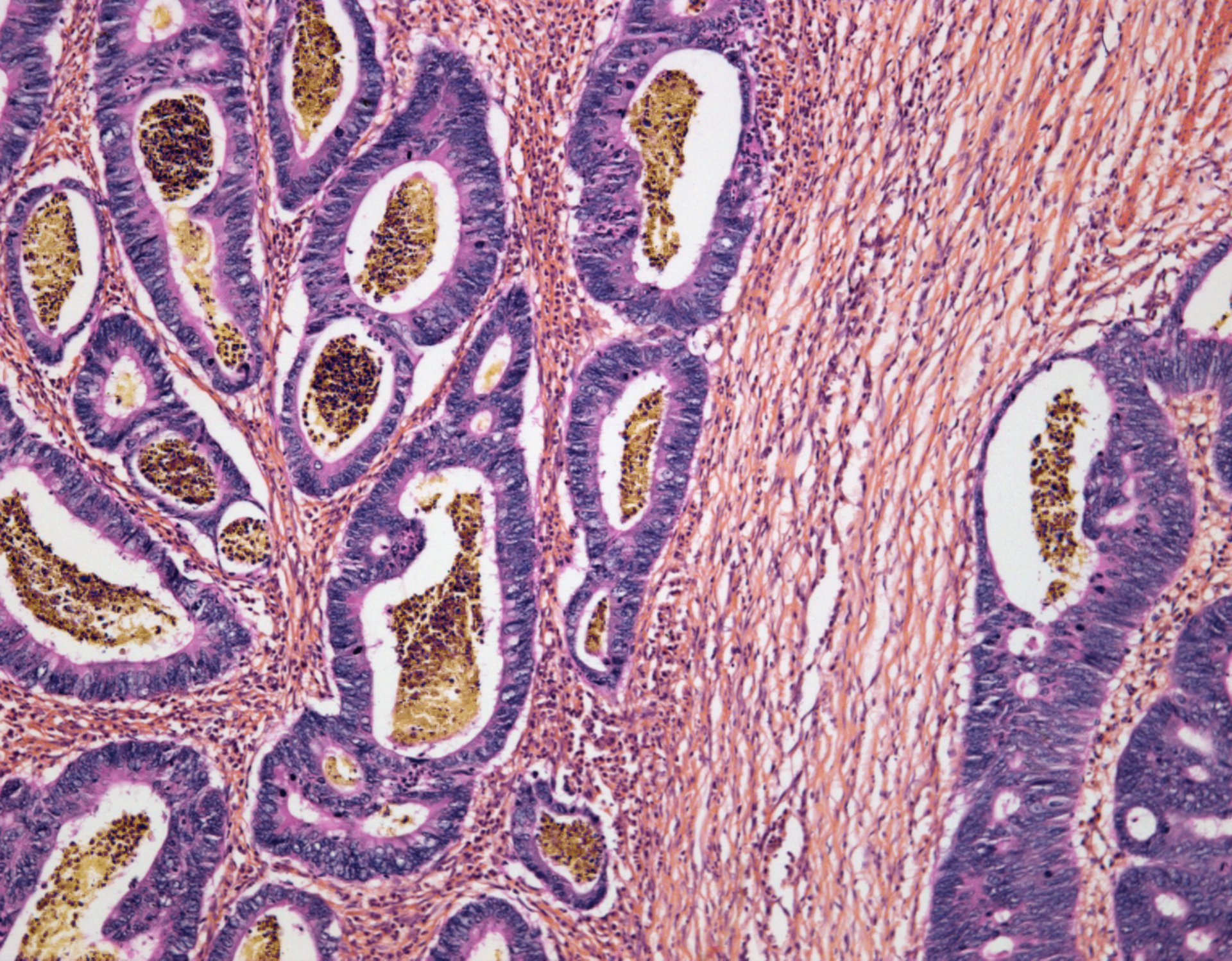 New Study Points to How Colorectal Cancer Starts
