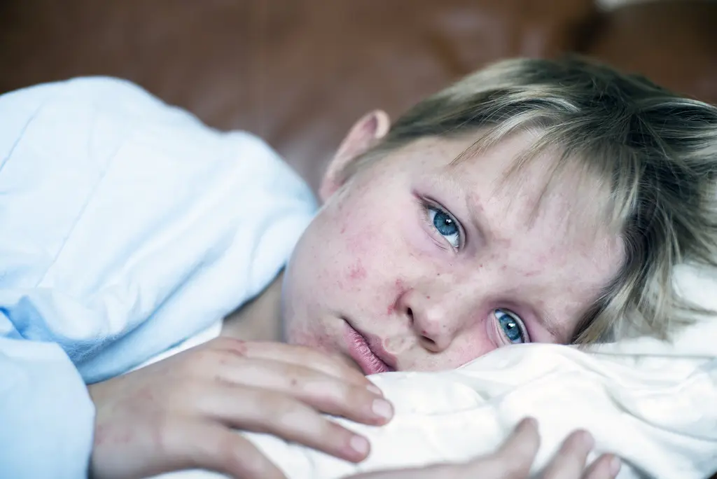 7 Things to Know About Measles