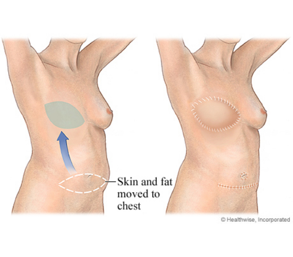 Diagram of DIEP flap procedure