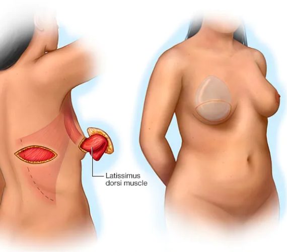 Diagram of latissimus procedure