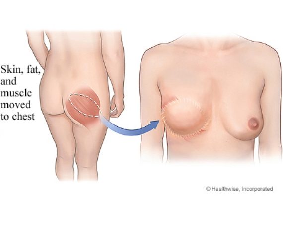 Diagram of sgap flap procedure