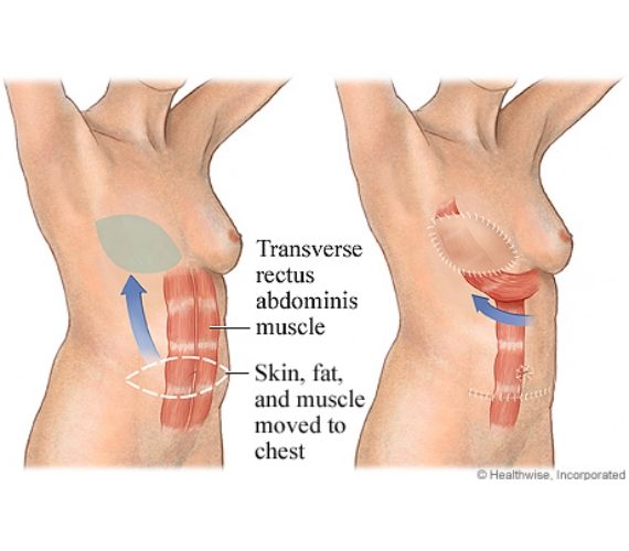 Diagram of tram flap procedure